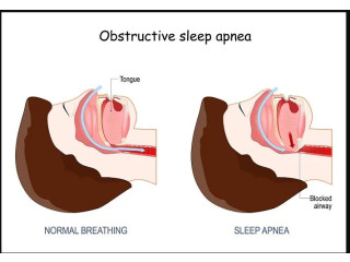 Best Sleep Apnea Doctor in Jaipur, Rajasthan – Dr. Virendra Singh