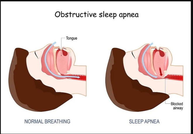 best-sleep-apnea-doctor-in-jaipur-rajasthan-dr-virendra-singh-big-0