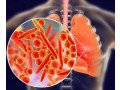 lung-cancer-diagnosis-treatment-specialist-in-ajmer-rajasthan-dr-sheetu-singh-small-0